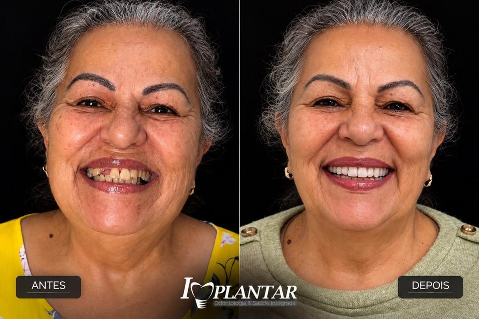 Antes e depois: paciente com dentes desgastados e depois com sorriso renovado