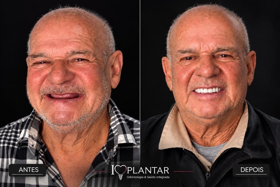 Antes e depois de paciente da Implantar com prótese protocolo